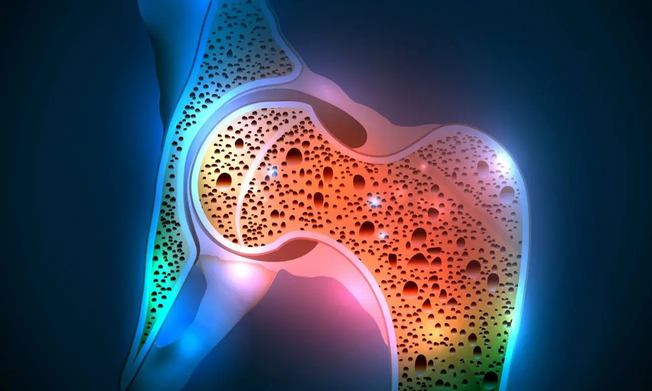 Allerta osteoporosi: i cibi che peggiorano la salute delle ossa